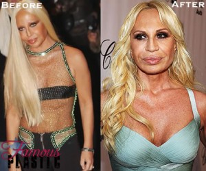 Donatella Versace Breast Implants